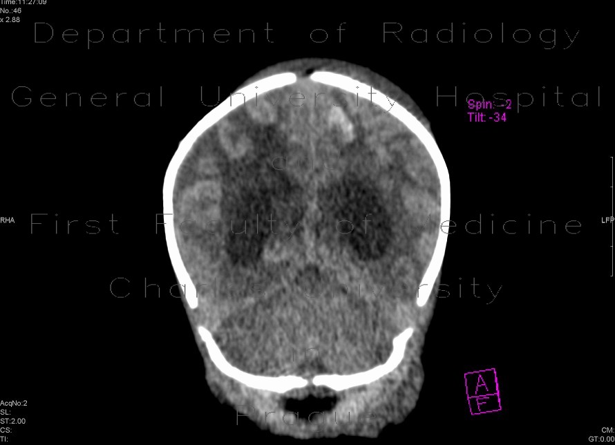 Meningencephalitis, abscessing