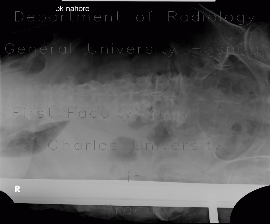 Pleural fluid, lateral view, decubitus view