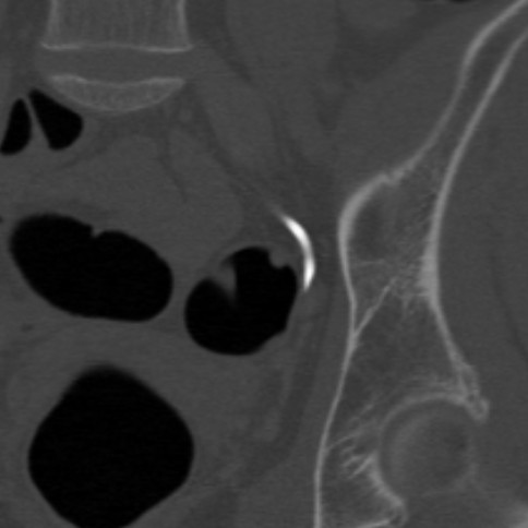 Radiology image - Polyp of sigmoid colon, dimitutive polyp, sessile polyp, CT colonography: Abdomen, Large bowel: CT - Computed tomography