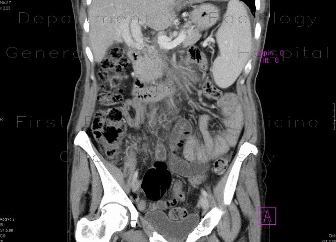 Portal cavernoma