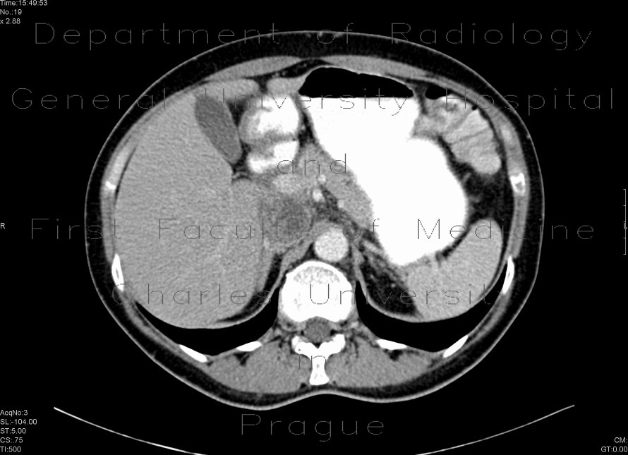 Tumorous mass in vena cava inferior